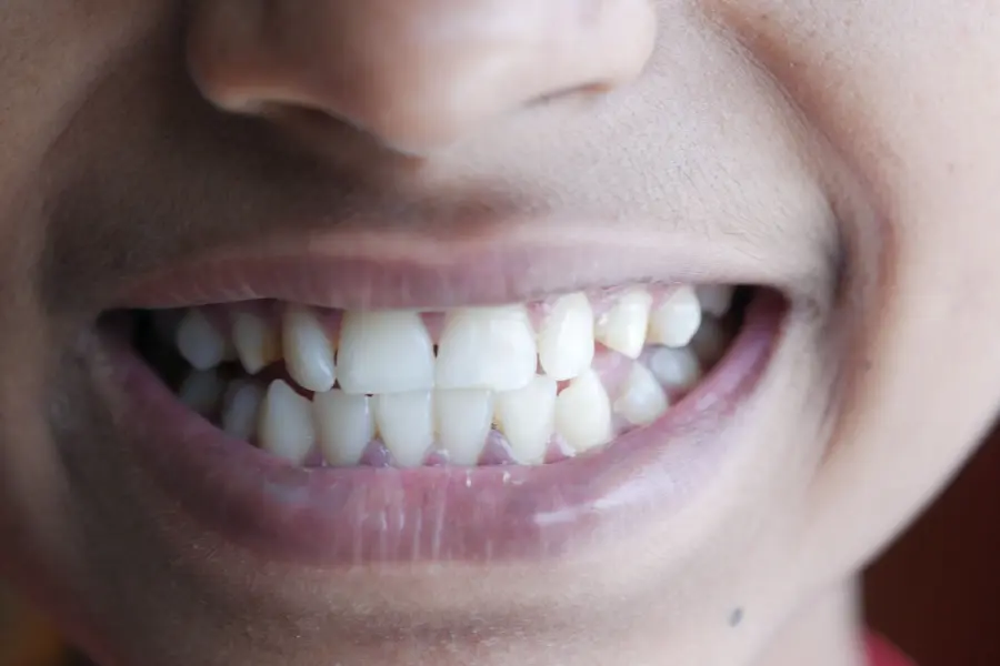Denti sporgenti: cause, conseguenze e soluzioni per correggerli