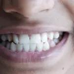 Denti sporgenti: cause, conseguenze e soluzioni per correggerli